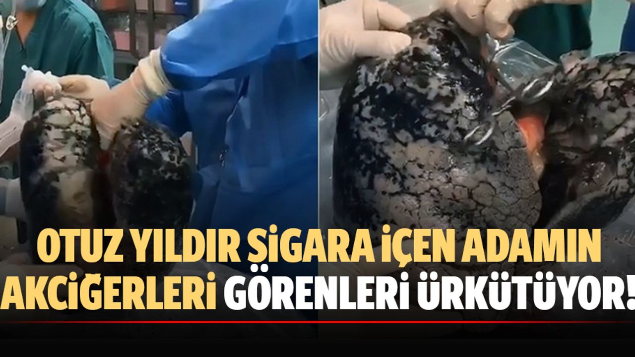 Otuz yıldır sigara içen adamın akciğerleri görenleri ürkütüyor!