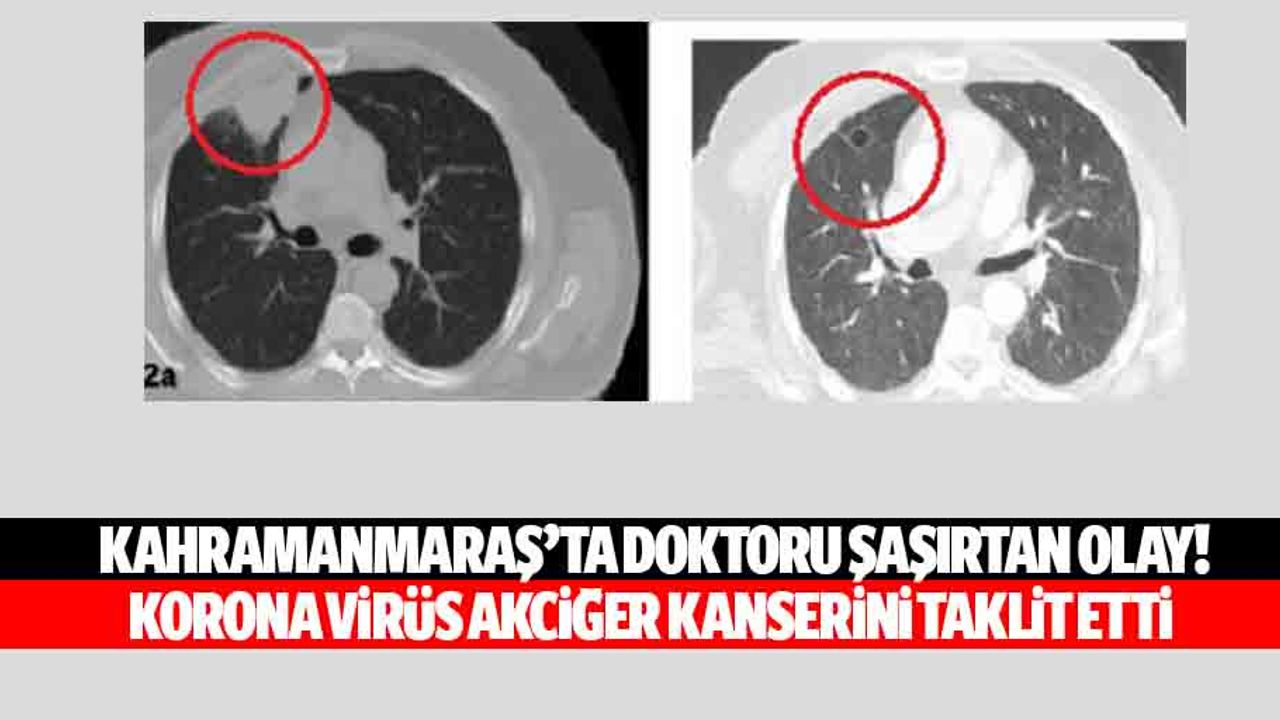 Kahramanmaraş’ta doktoru şaşırtan olay! Korona virüs akciğer kanserini taklit etti