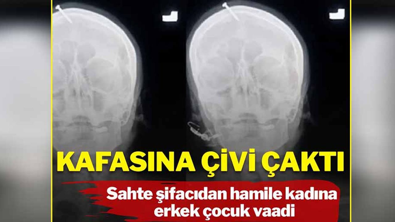 Erkek çocuk doğurmak için kafasına çivi çaktırdı